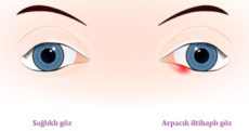 Gözde oluşan arpacık iltihabı